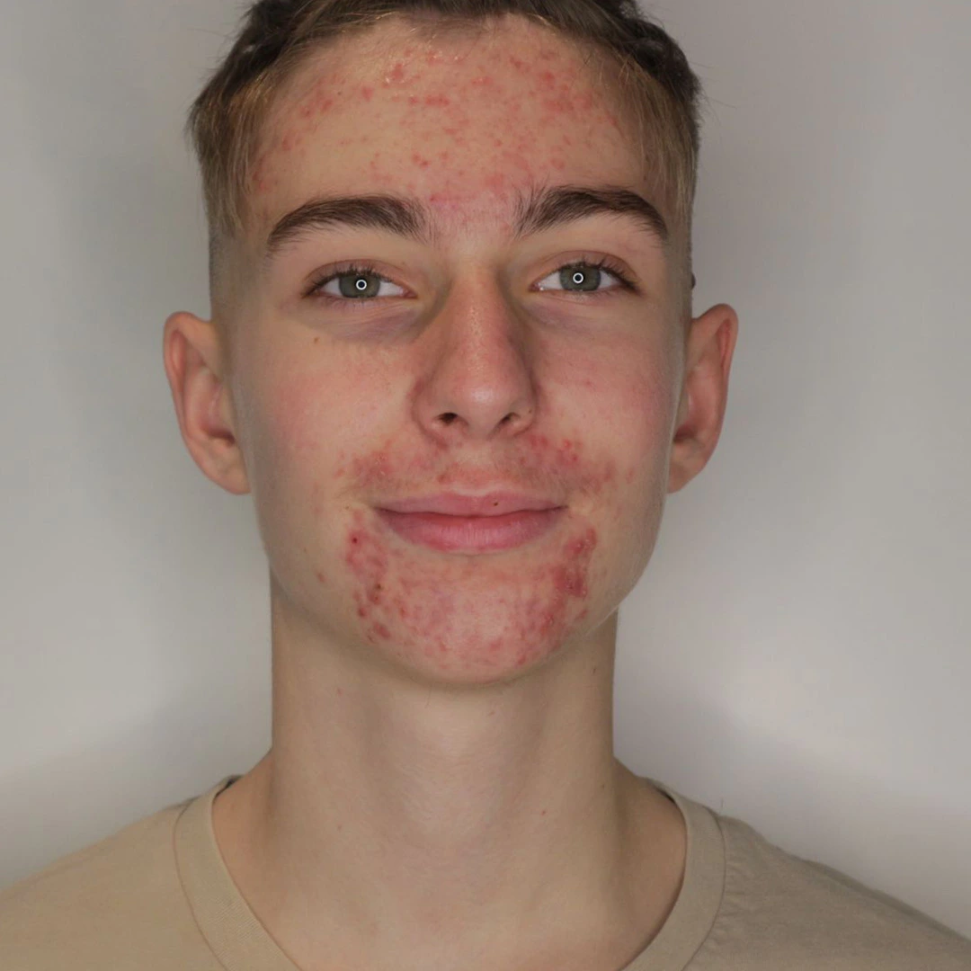 Matteo Resultate Skin Clear Young  irritierte Haut pickel Before