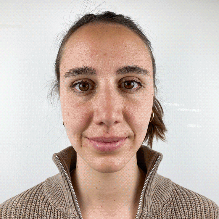 Aline Resultate Skin Clear Adult ölige Haut Pickel