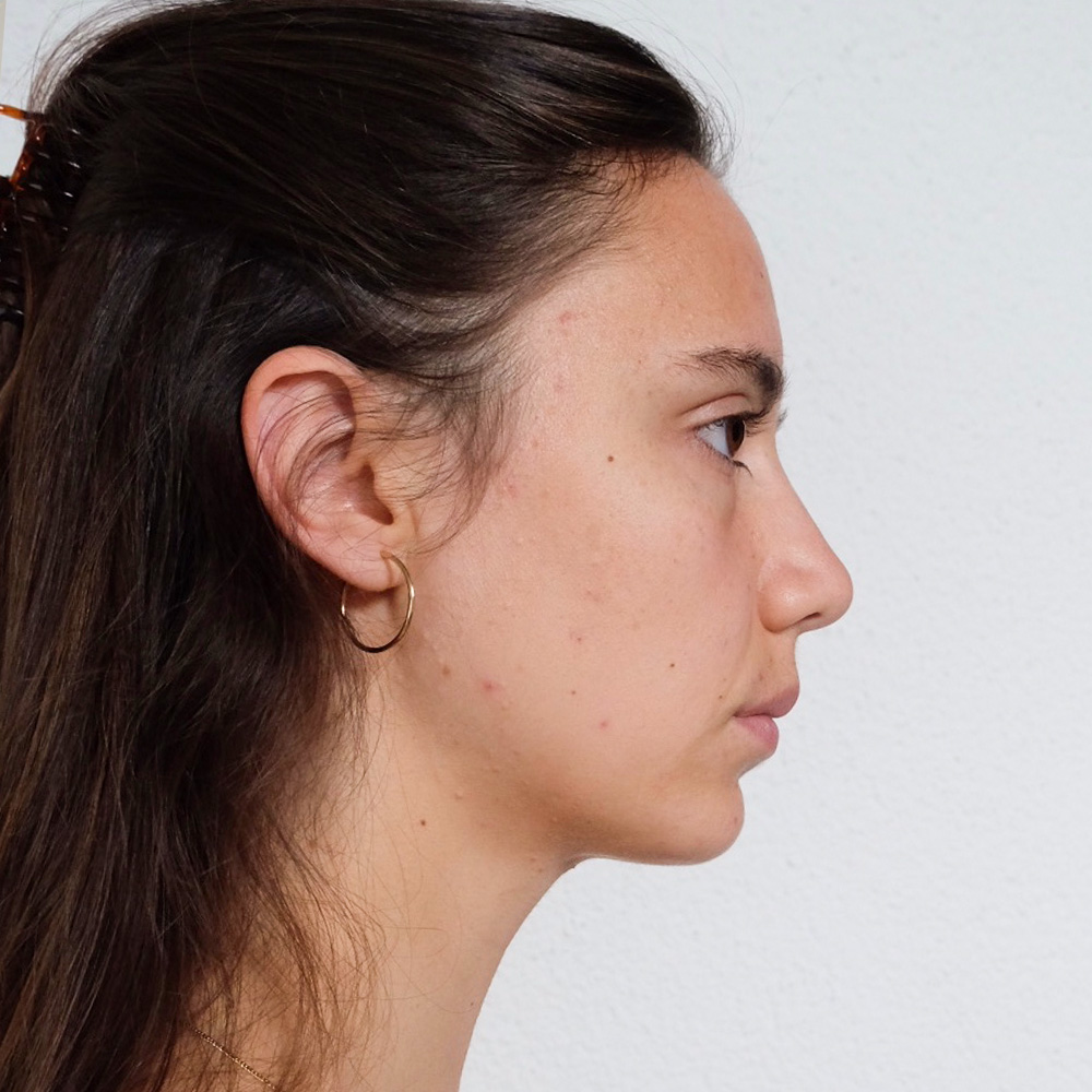 Aline Resultate Skin Clear Adult ölige Haut Pickel After