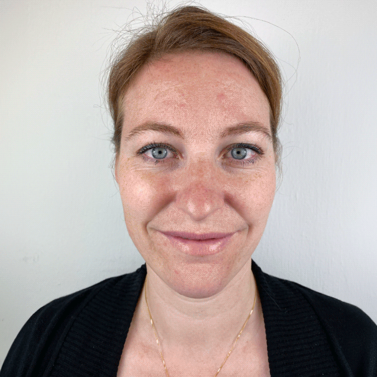 Andrea Pigmentstörungen Behandlung Pigmentflecken Altersflecken