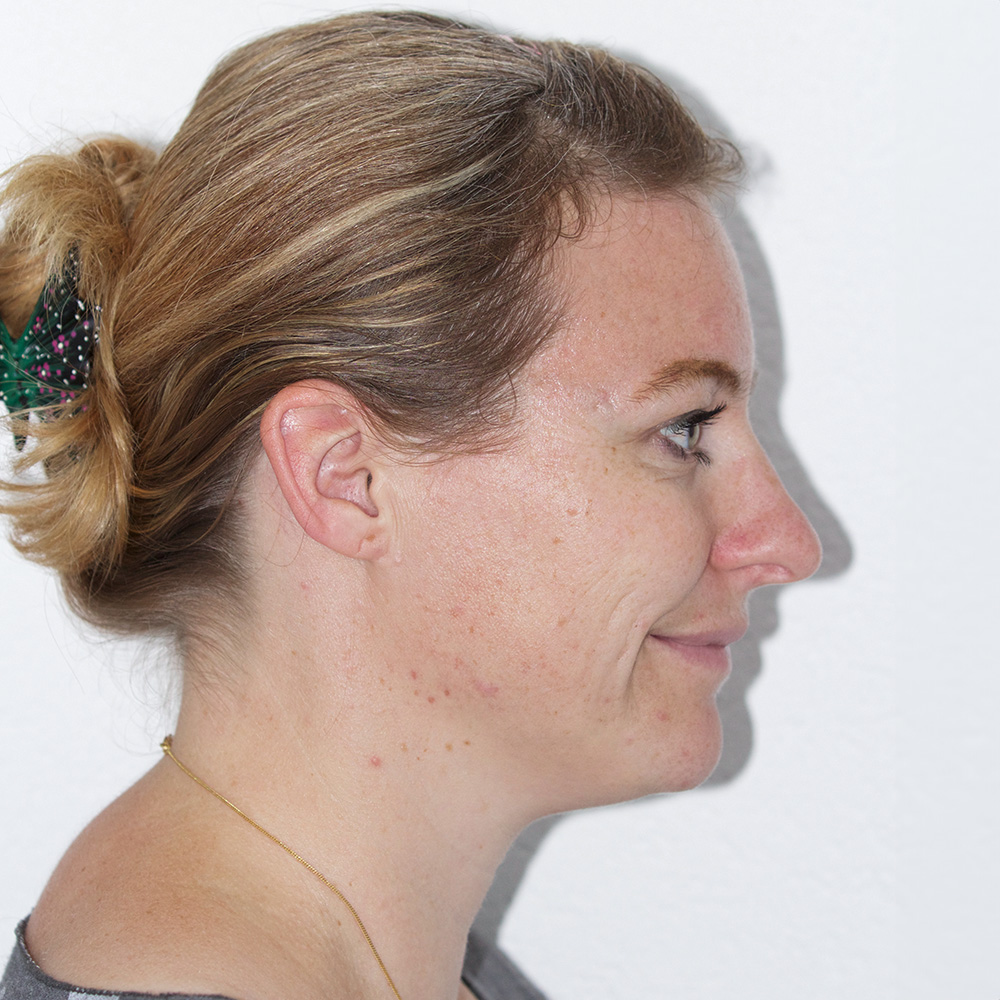 Andrea Pigmentstörungen Behandlung Pigmentflecken Altersflecken after