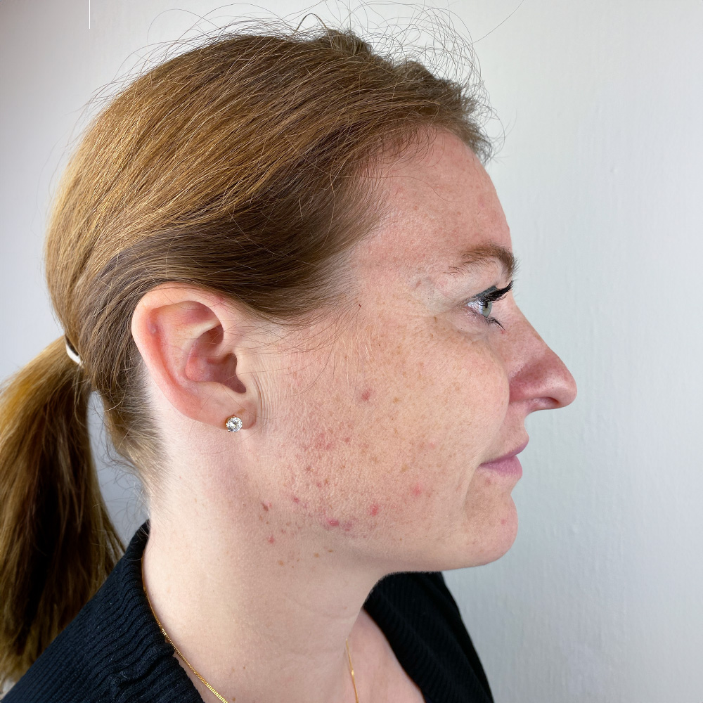 Andrea Pigmentstörungen Behandlung Pigmentflecken Altersflecken before