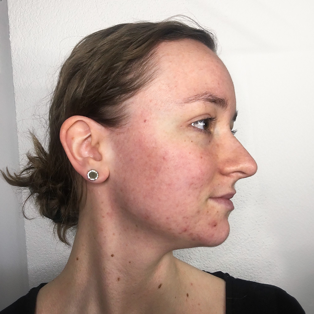 Celine Resultate Irritated Skin trockener Haut Pickeln Mitessern Flecken After