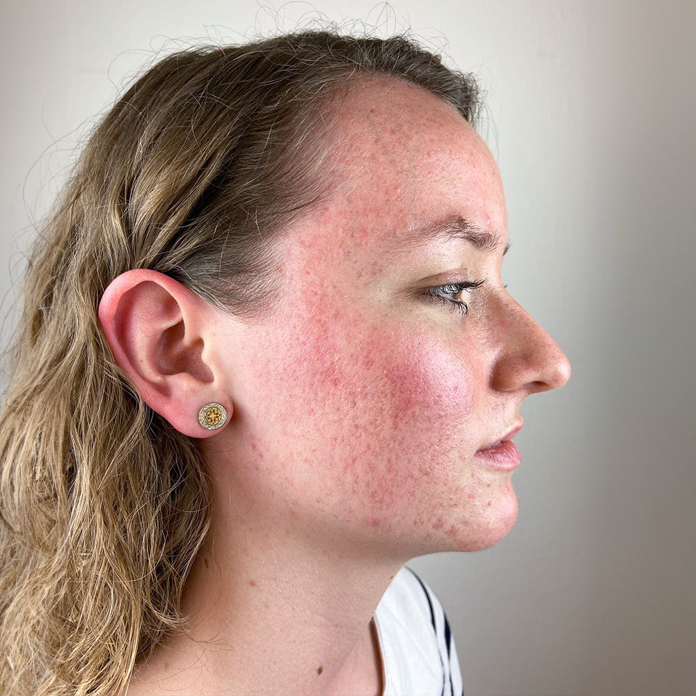 Celine Resultate Irritated Skin trockener Haut Pickeln Mitessern Flecken Before