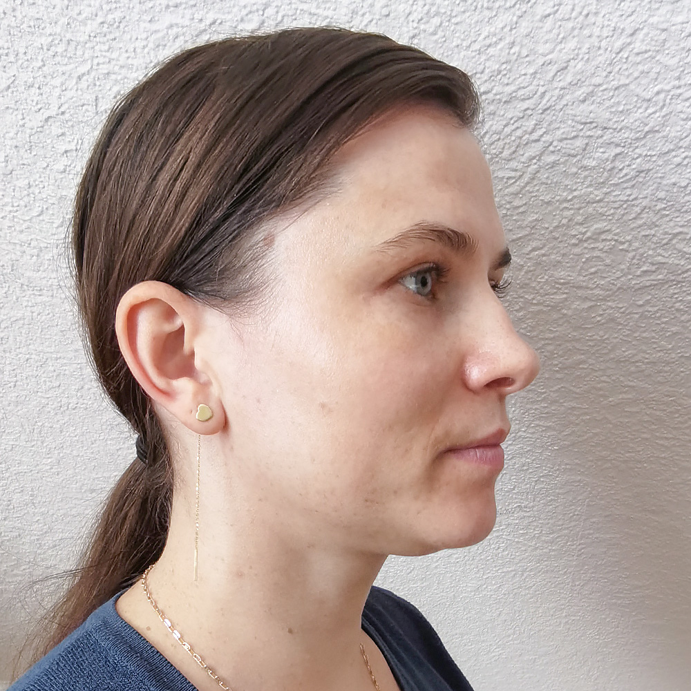 Cristina Behandlung Pigmentflecken Altersflecken after