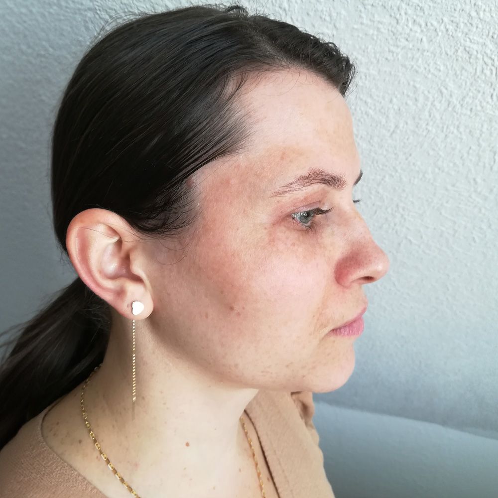 Cristina Behandlung Pigmentflecken Altersflecken before