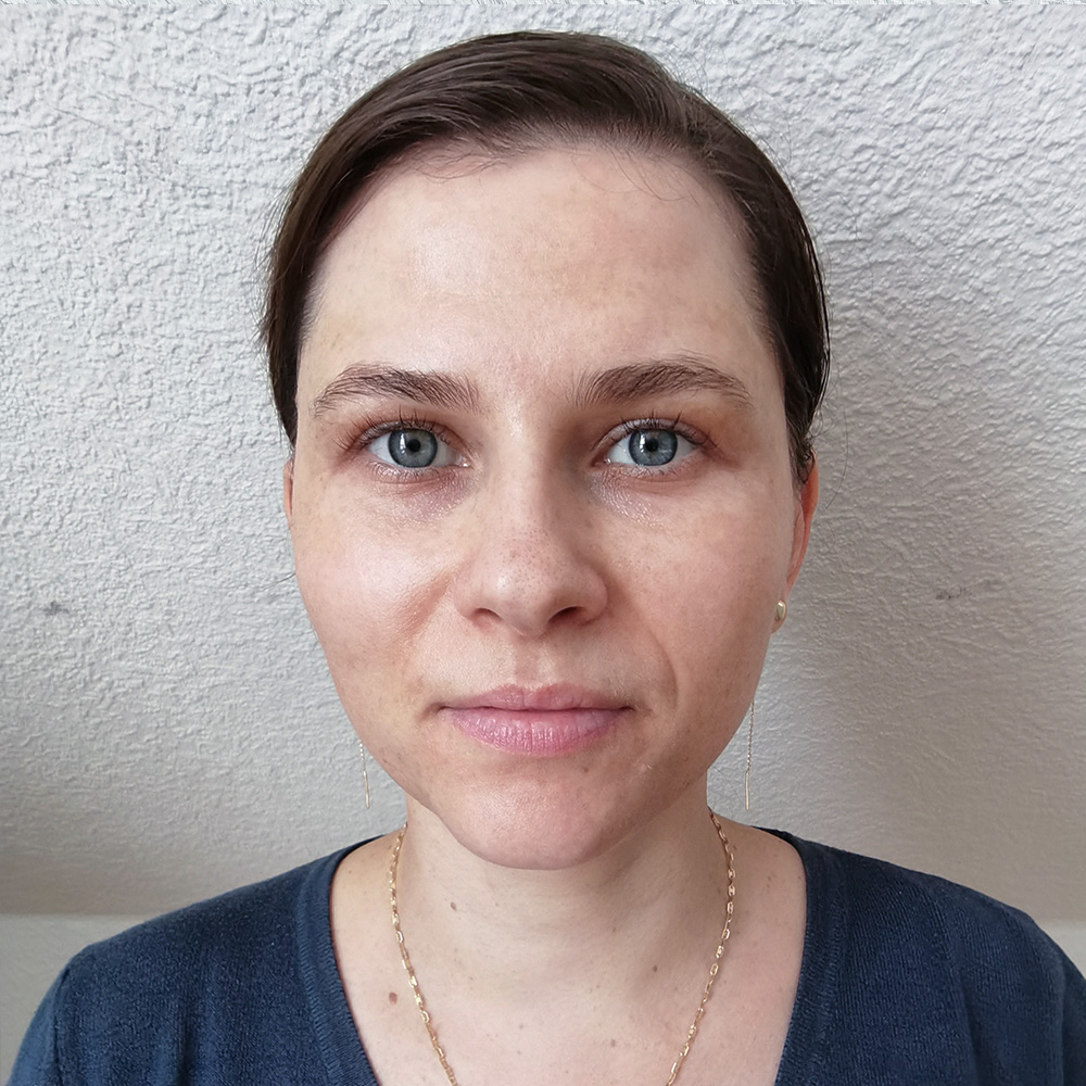 Cristina Behandlung Pigmentflecken Altersflecken after