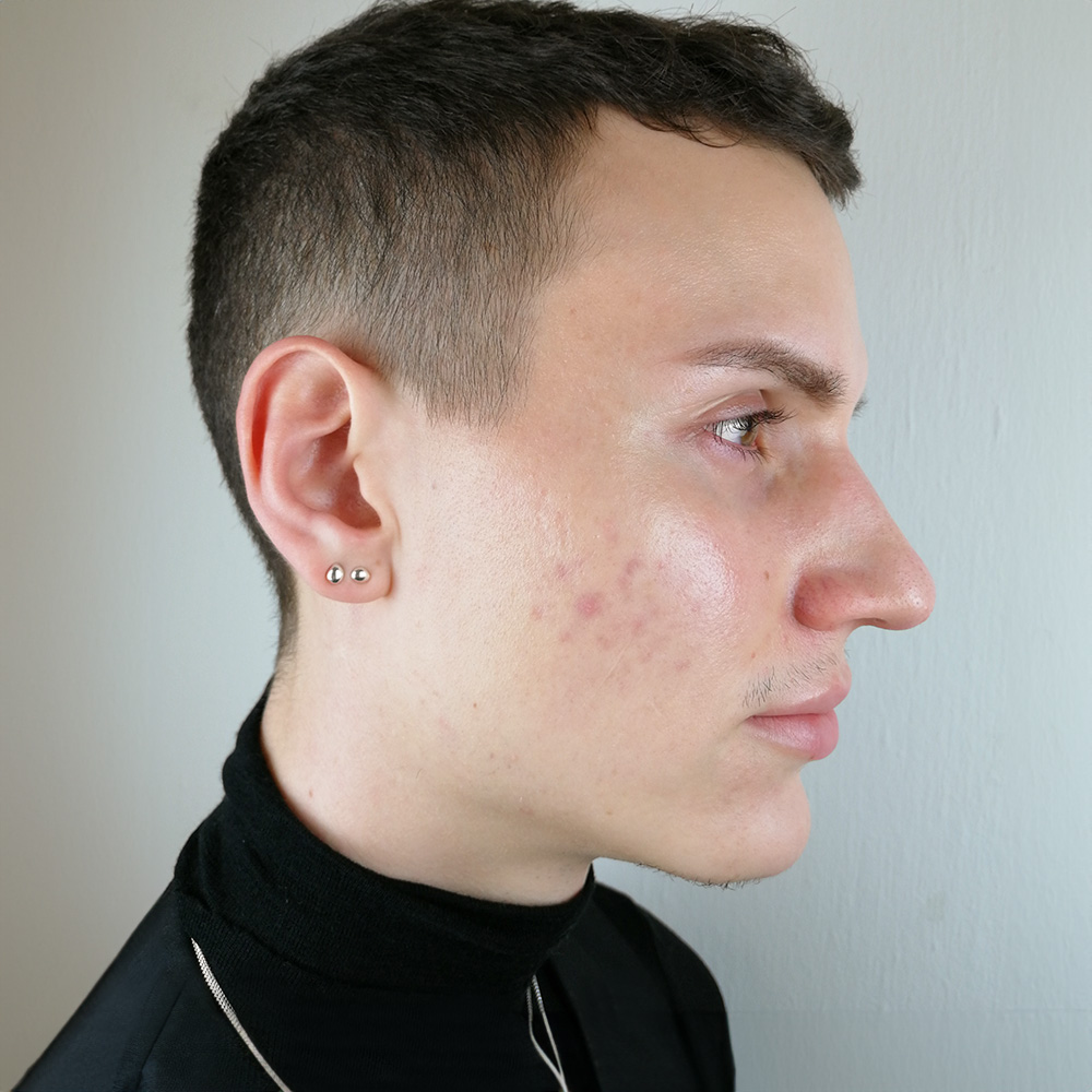 Cyrill Resultate Skin Clear Adult fettiger ölige Haut Pickel Before