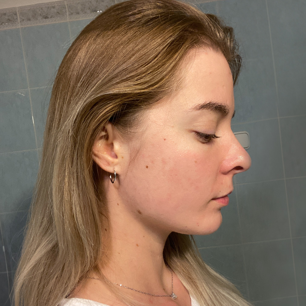 Emese Resultate Mixed Skin fettige ölige Haut pickel After