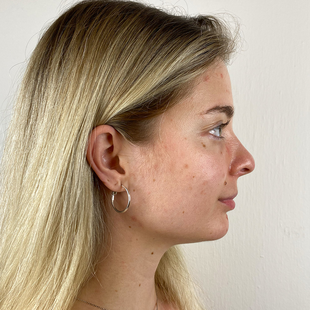 Emese Resultate Mixed Skin fettige ölige Haut pickel Before