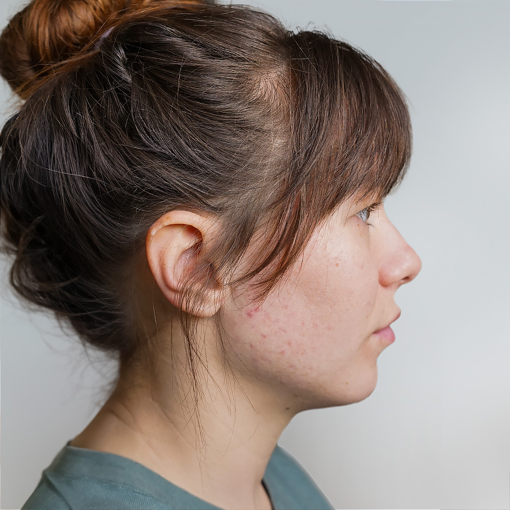 Gina Resultate Skin Clear Adult ölige Haut Pickel After