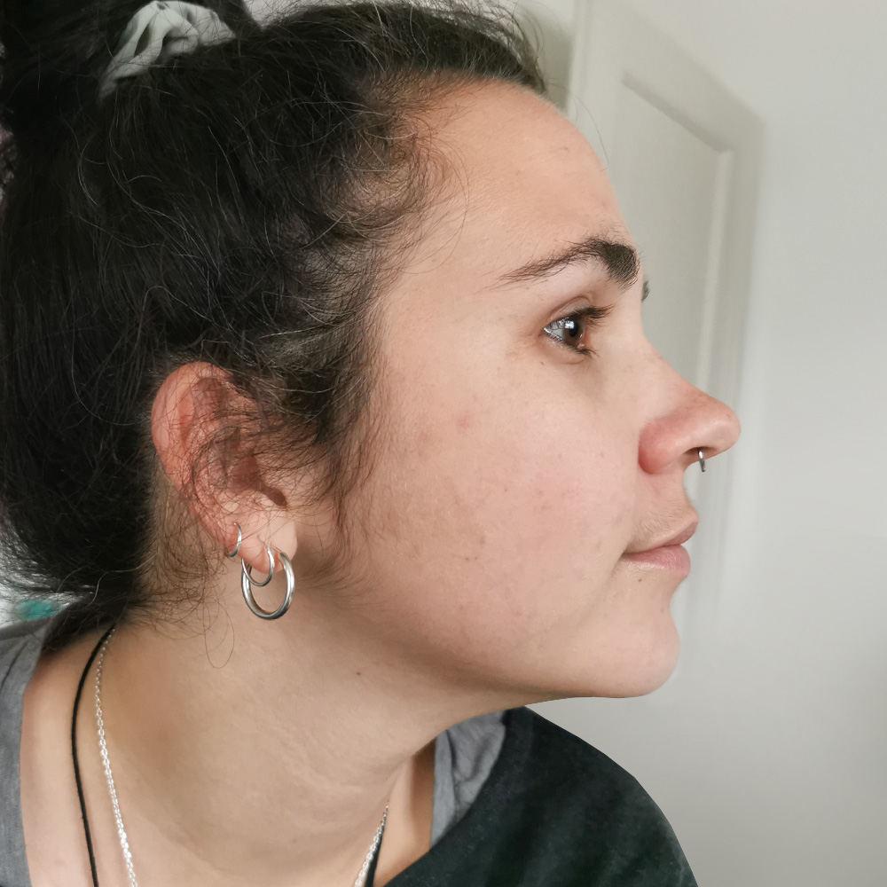 Gloria Resultate Balanced Skin Ekzem irritierte Haut pickel After