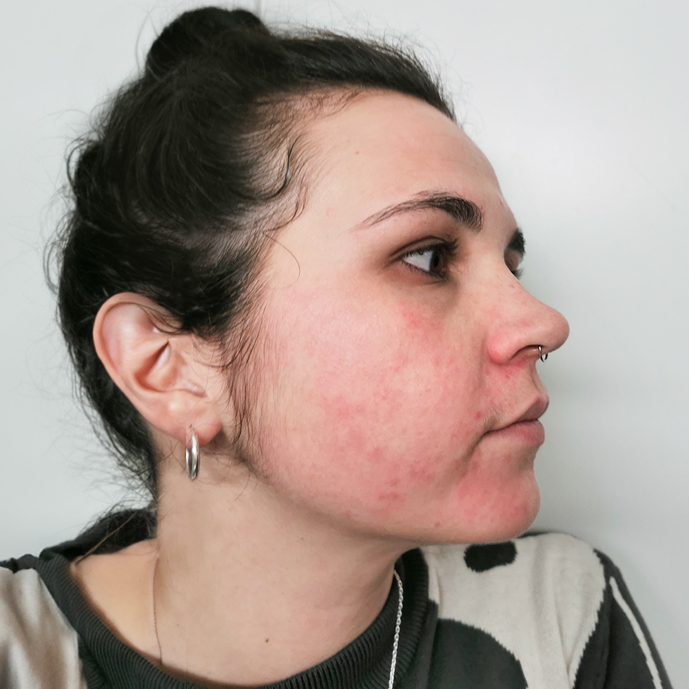 Gloria Resultate Balanced Skin Ekzem irritierte Haut pickel Before