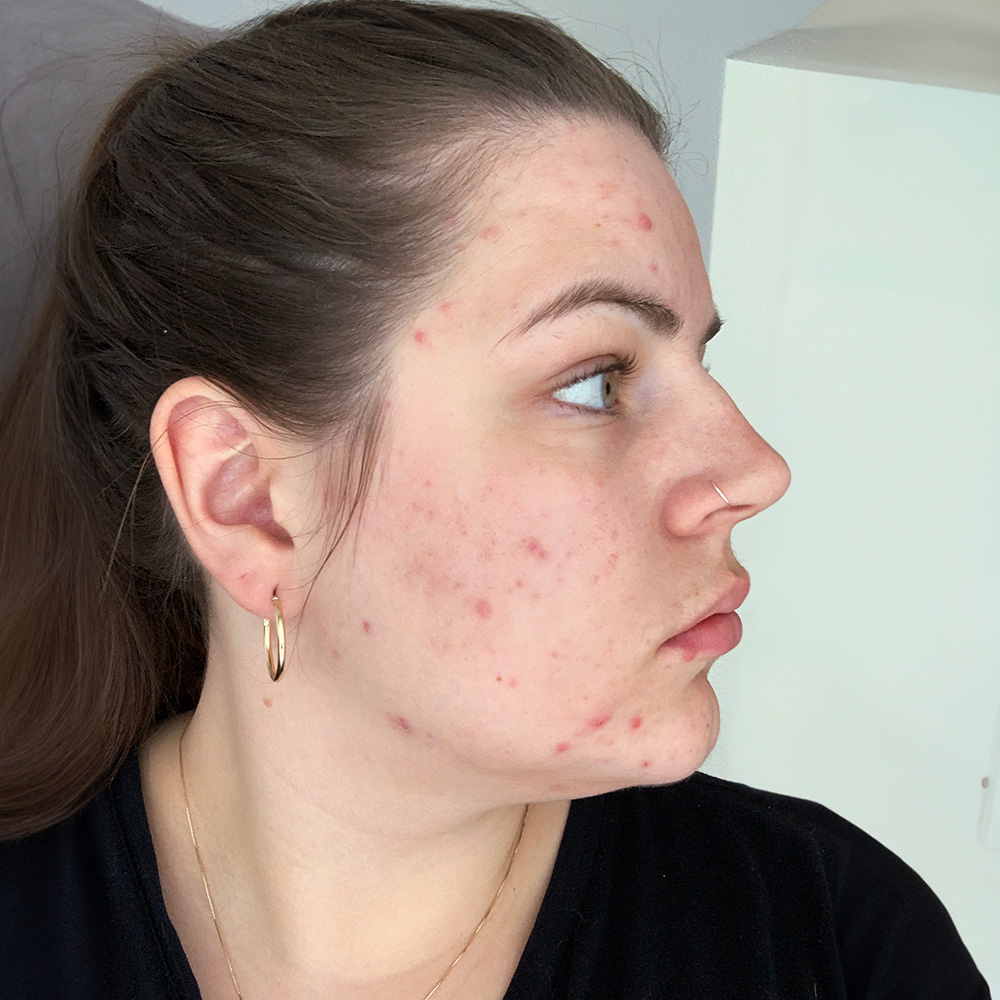 Jacqueline Resultate Skin Clear Dry Haut Unreinheiten Flecken Pickel After