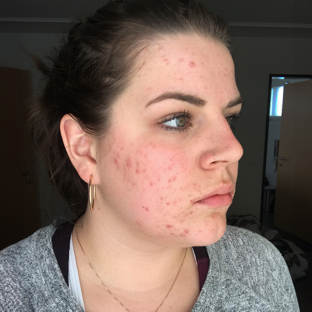 Jacqueline Resultate Skin Clear Dry Haut Unreinheiten Flecken Pickel Before