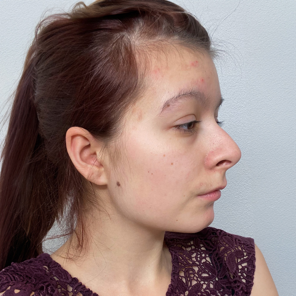 Julia Resultate Balanced Skin Ekzem irritierte Haut pickel after