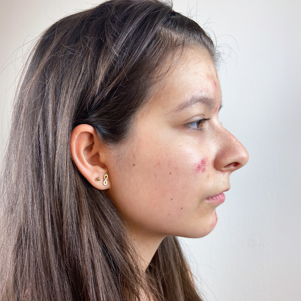 Julia Resultate Balanced Skin Ekzem irritierte Haut pickel before