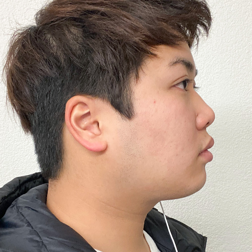 Kyle Resultate Skin Clear Adult fettiger Haut Pickeln After