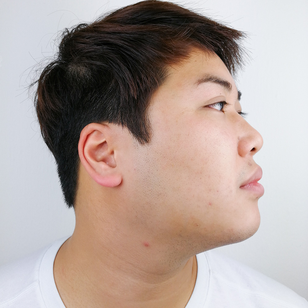 Kyle Resultate Skin Clear Adult fettiger Haut Pickeln Before