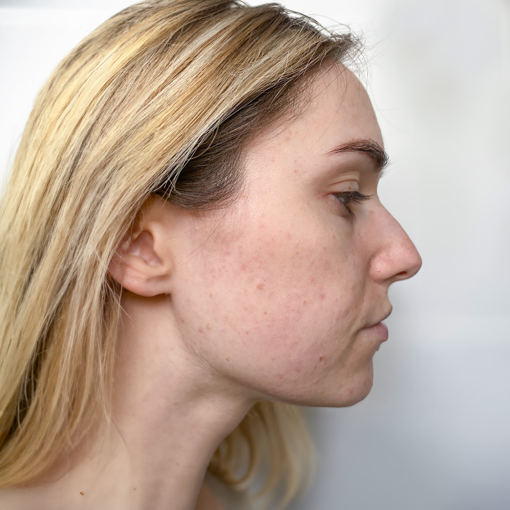 Larissa Resultate Skin Clear Dry Haut Unreinheiten Flecken Pickel After