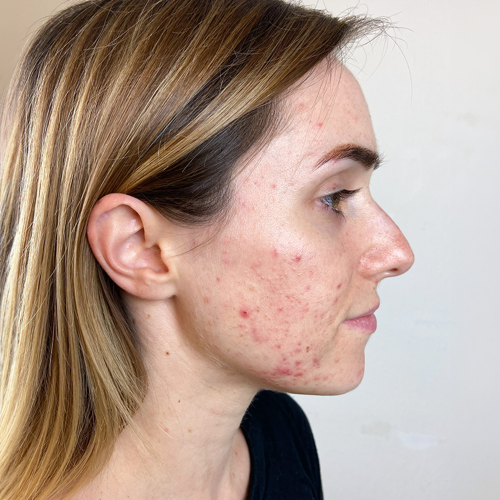 Larissa Resultate Skin Clear Dry Haut Unreinheiten Flecken Pickel Before