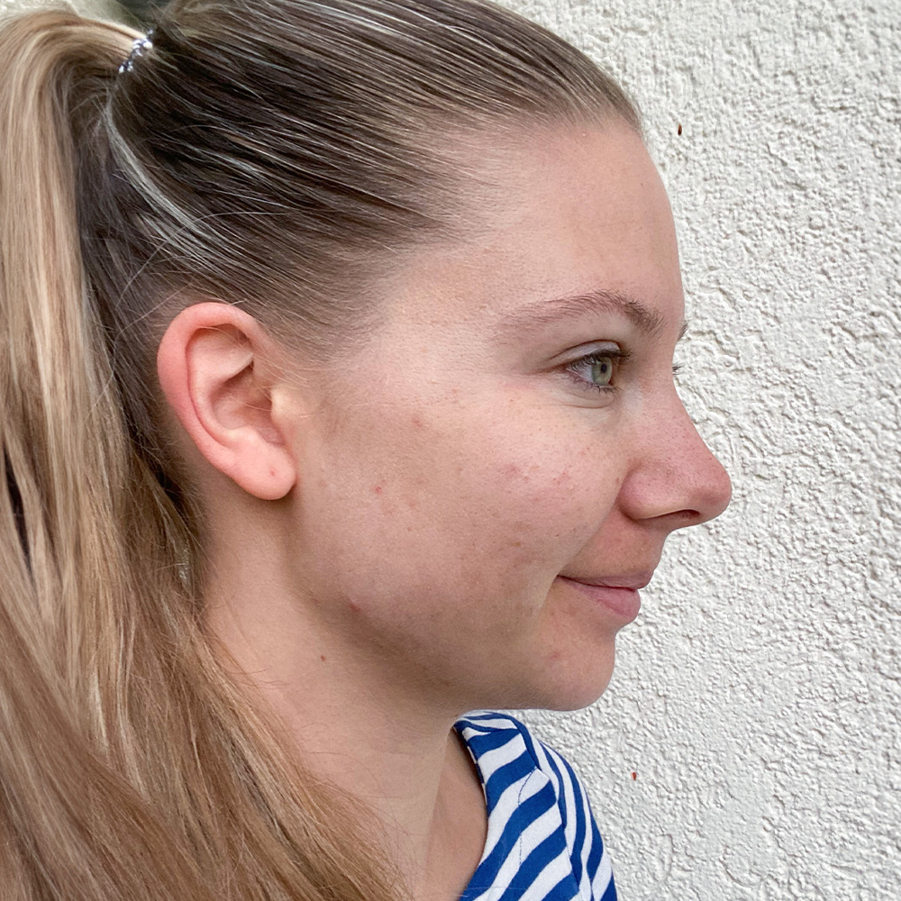 Livia Resultate Irritated Skin trockener Haut Pickeln Mitessern Flecken After