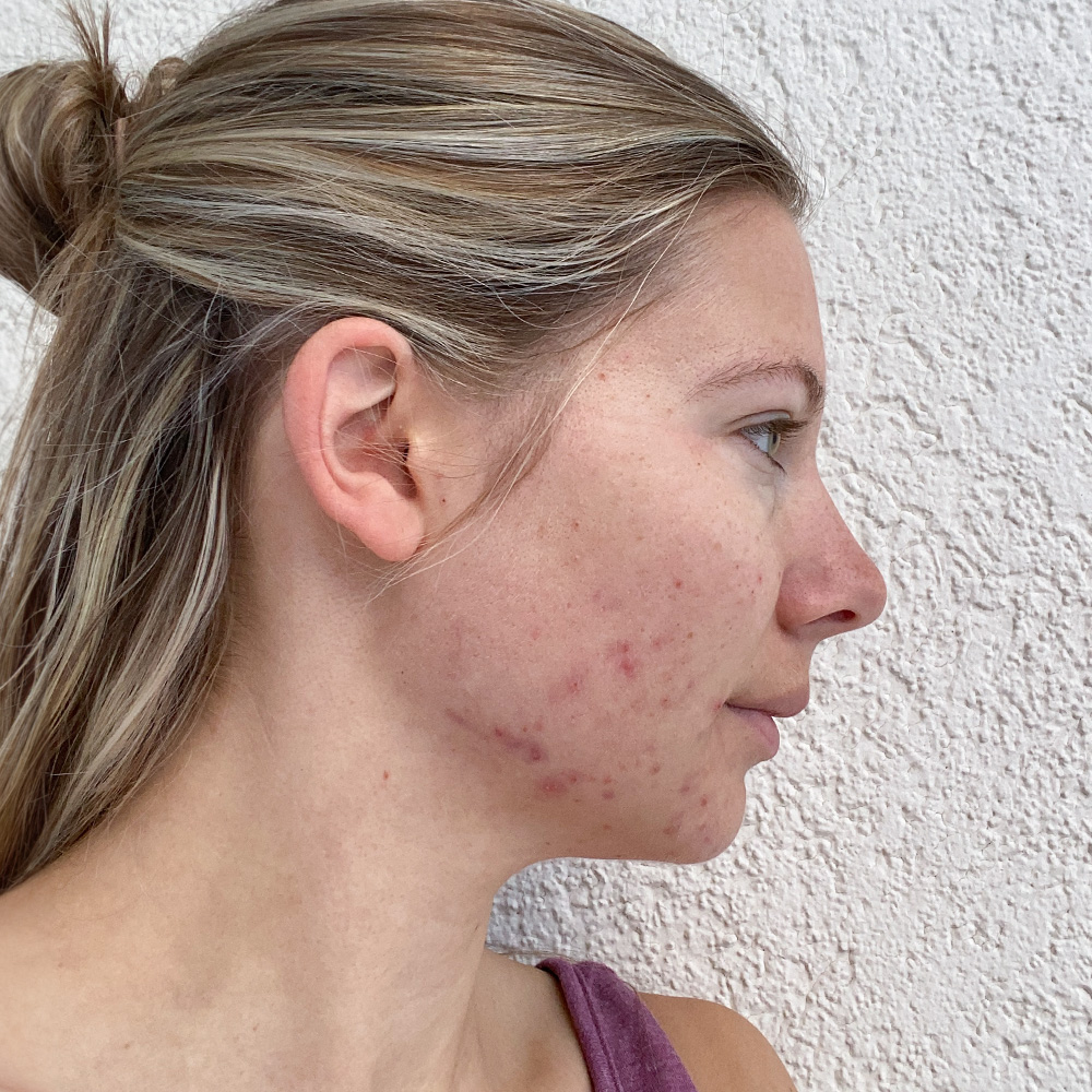 Livia Resultate Irritated Skin trockener Haut Pickeln Mitessern Flecken Before