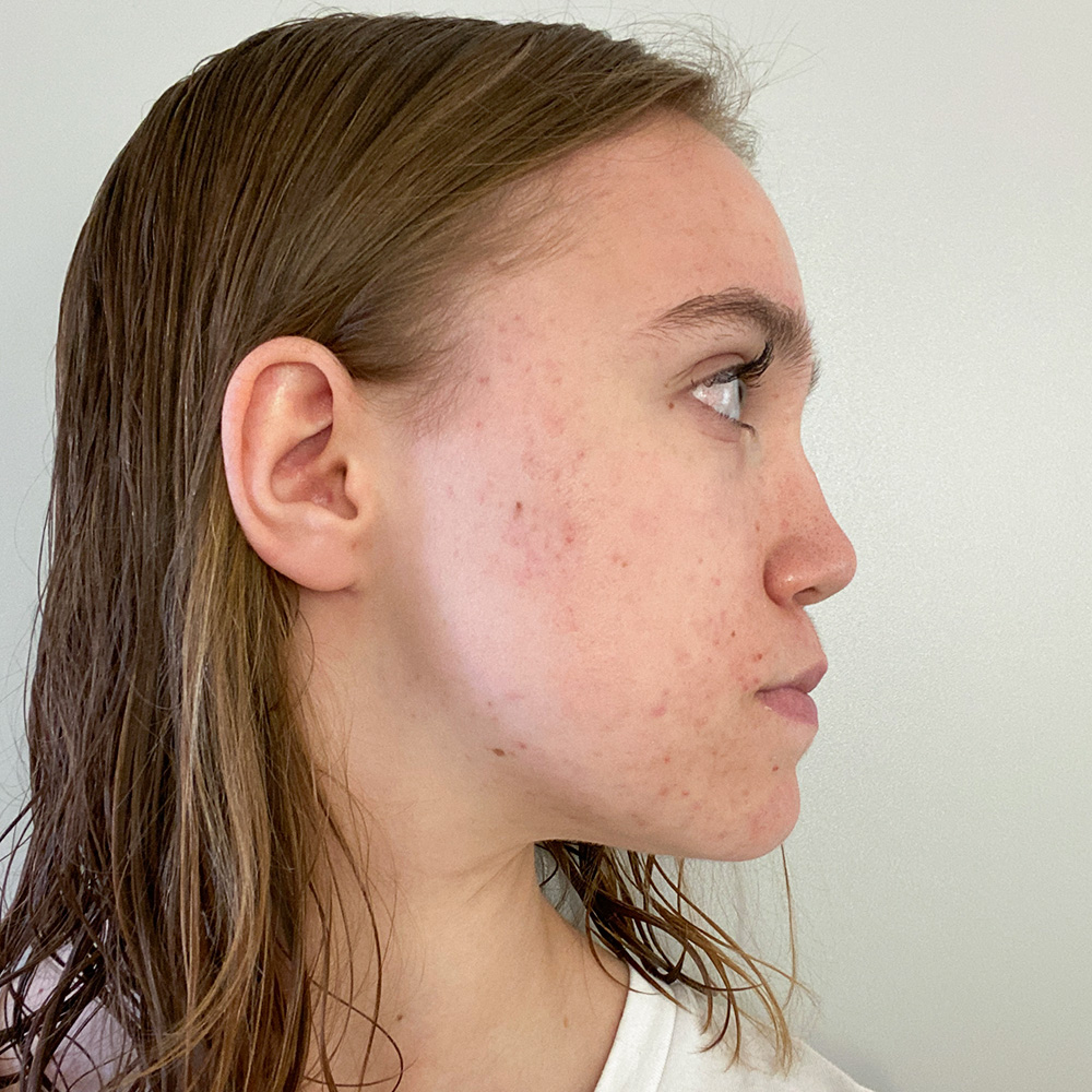 Malin Resultate Skin Clear Young irritierte Haut pickel After