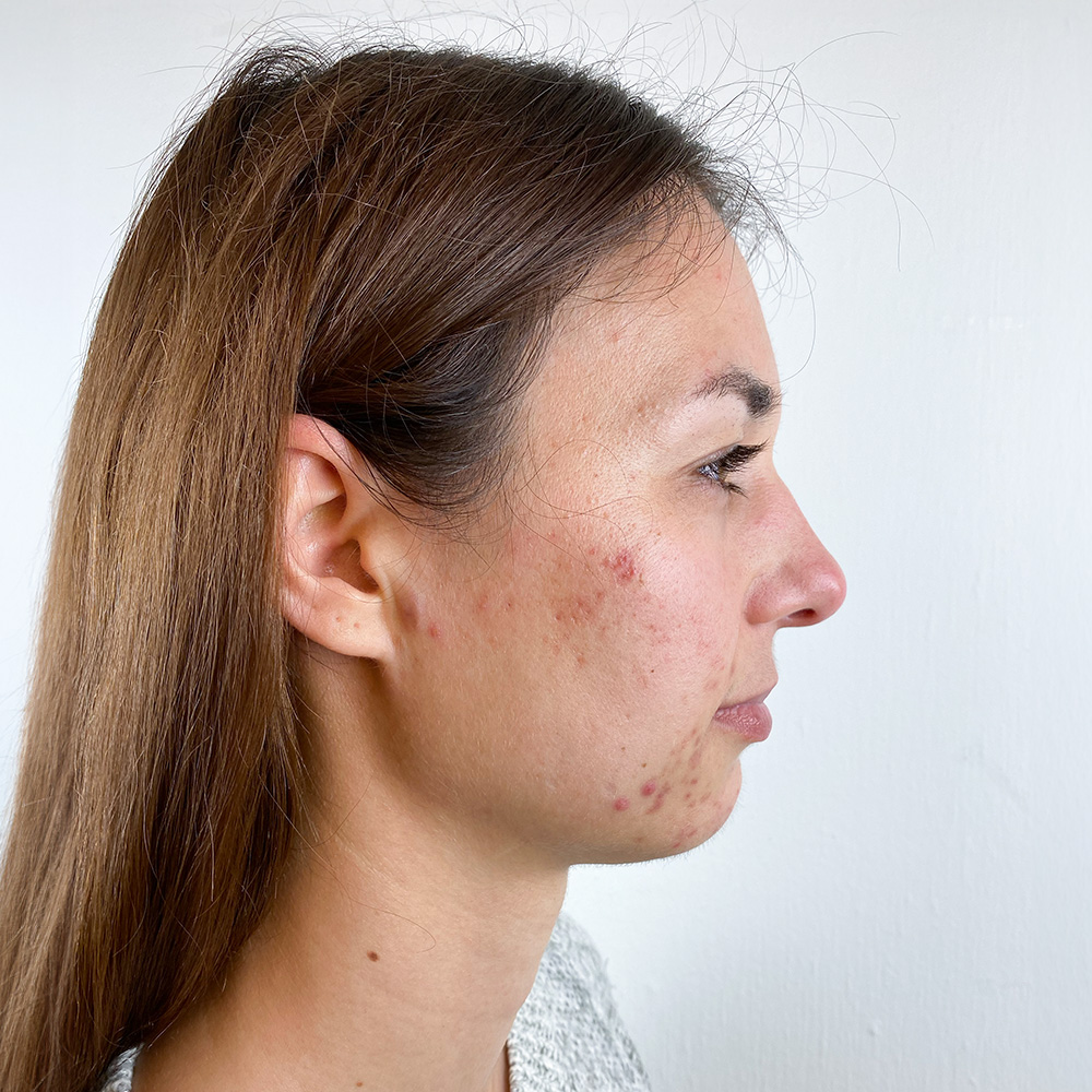 Michelle Resultate Skin Clear Adult ölige Haut Pickel Before