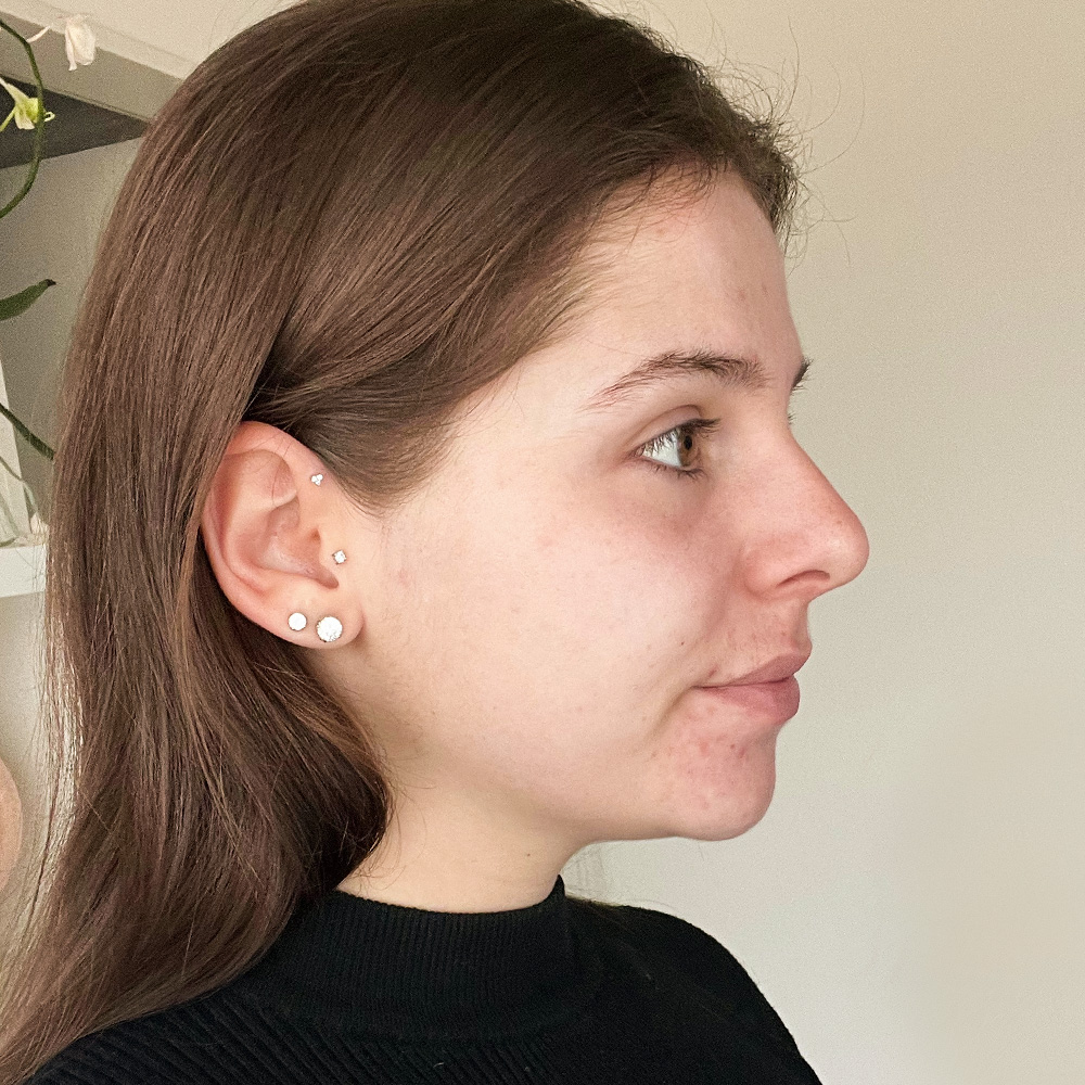 Michelle Resultate Mixed Skin T-Zone fettiger Haut Pickeln Flecken After