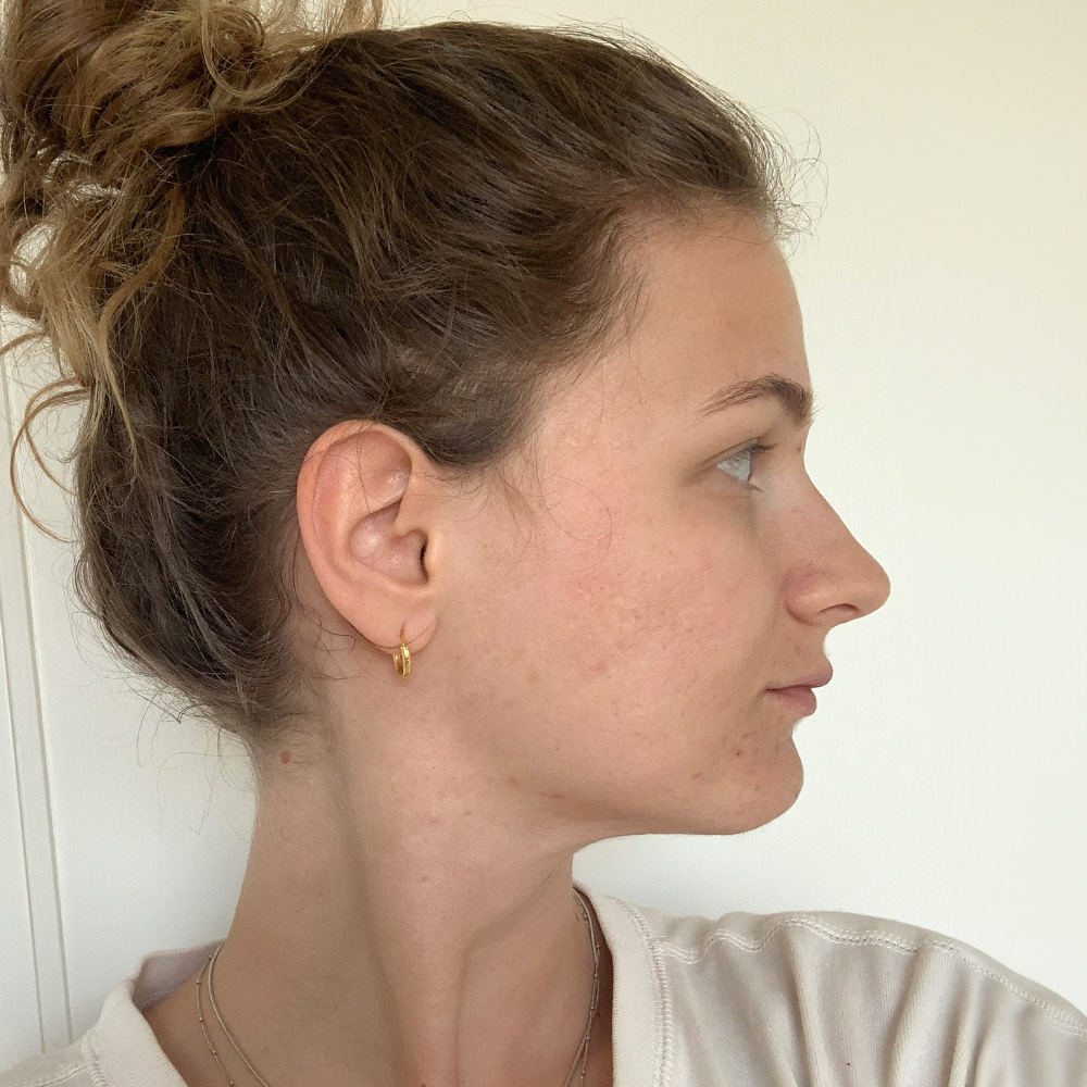 Momo Resultate Balanced Skin Ekzem irritierte Haut pickel Resultate after