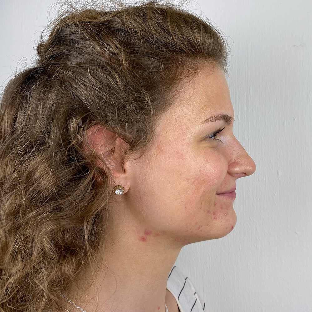 Momo Resultate Balanced Skin Ekzem irritierte Haut pickel Resultate before