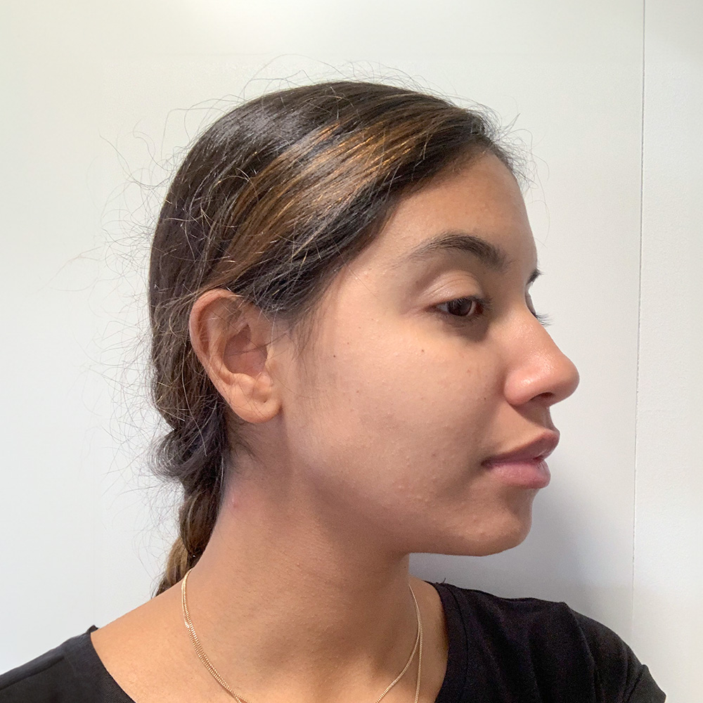 Monica Resultate Balanced Skin Ekzem irritierte Haut pickel Resultate after