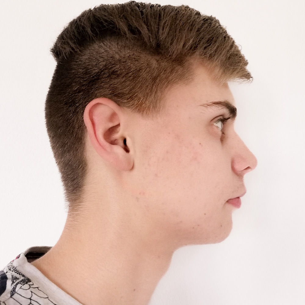 Moritz Resultate Skin Clear Young fettiger ölige Haut Unreinheiten Pickeln Mitessern After