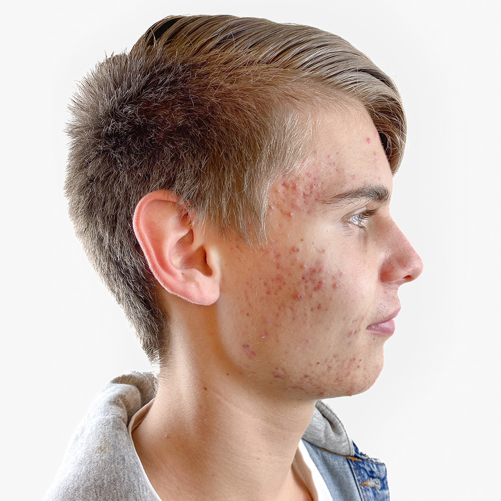 Moritz Resultate Skin Clear Young fettiger ölige Haut Unreinheiten Pickeln Mitessern Before