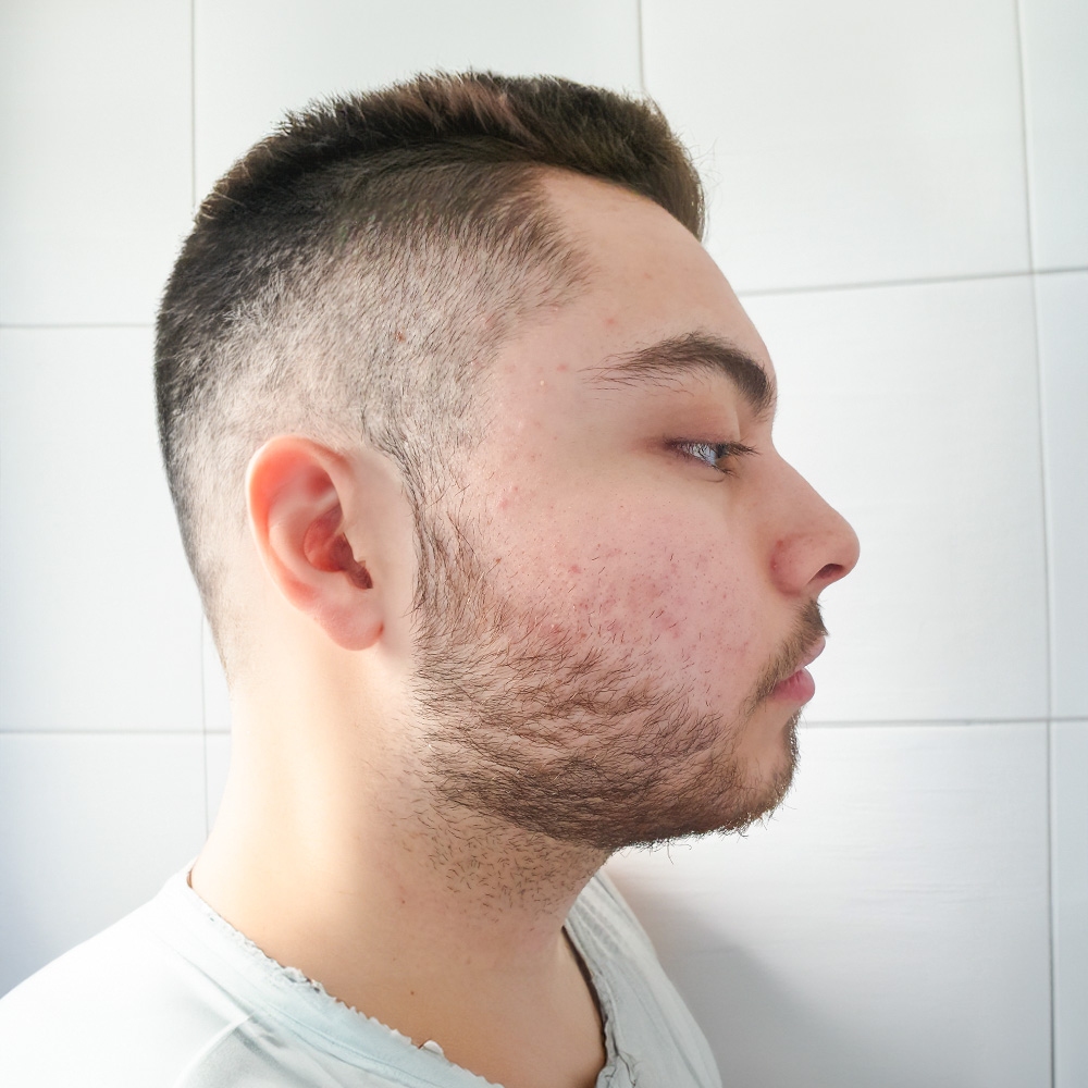 Patrick Resultate Irritated Skin trockener Haut Pickeln Mitessern Flecken After