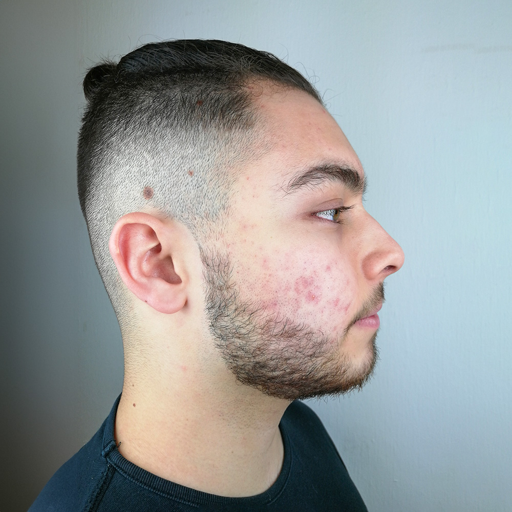 Patrick Resultate Irritated Skin trockener Haut Pickeln Mitessern Flecken Before