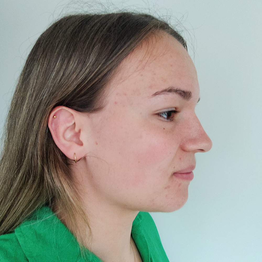 Petra Resultate Mixed Skin T-Zone fettiger Haut Pickeln Flecken after