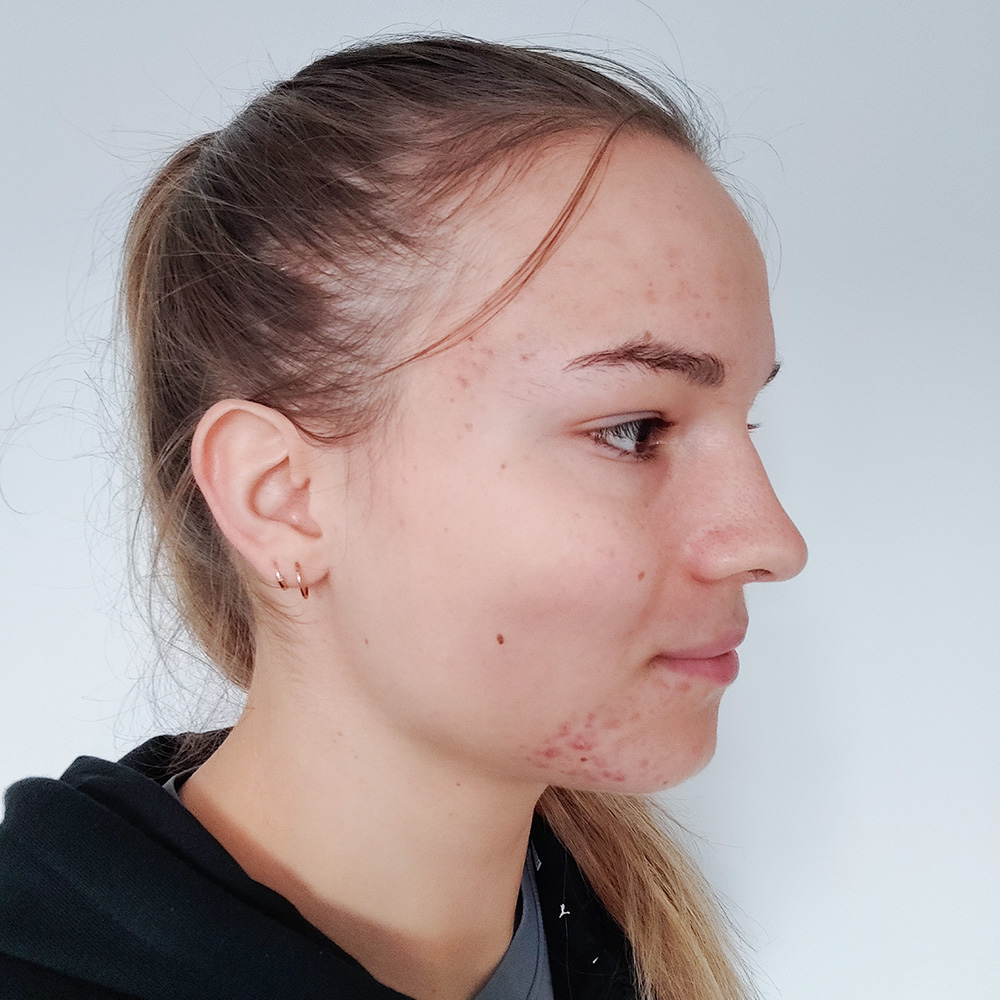 Petra Resultate Mixed Skin T-Zone fettiger Haut Pickeln Flecken Before