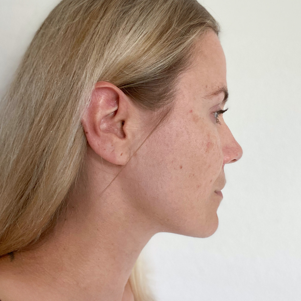 Sabrina Resultate Mixed Skin T-Zone fettiger Haut Pickeln Flecken After