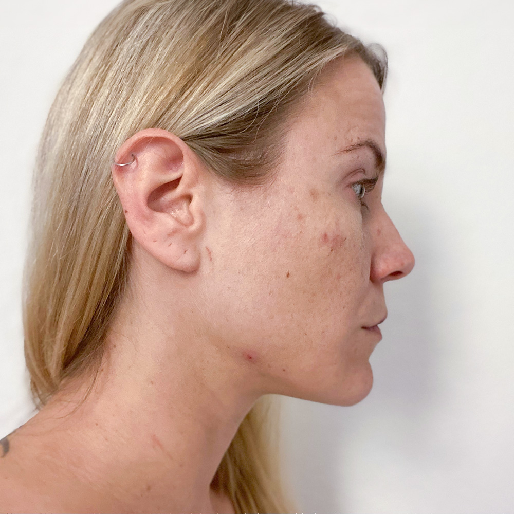 Sabrina Resultate Mixed Skin T-Zone fettiger Haut Pickeln Flecken Before