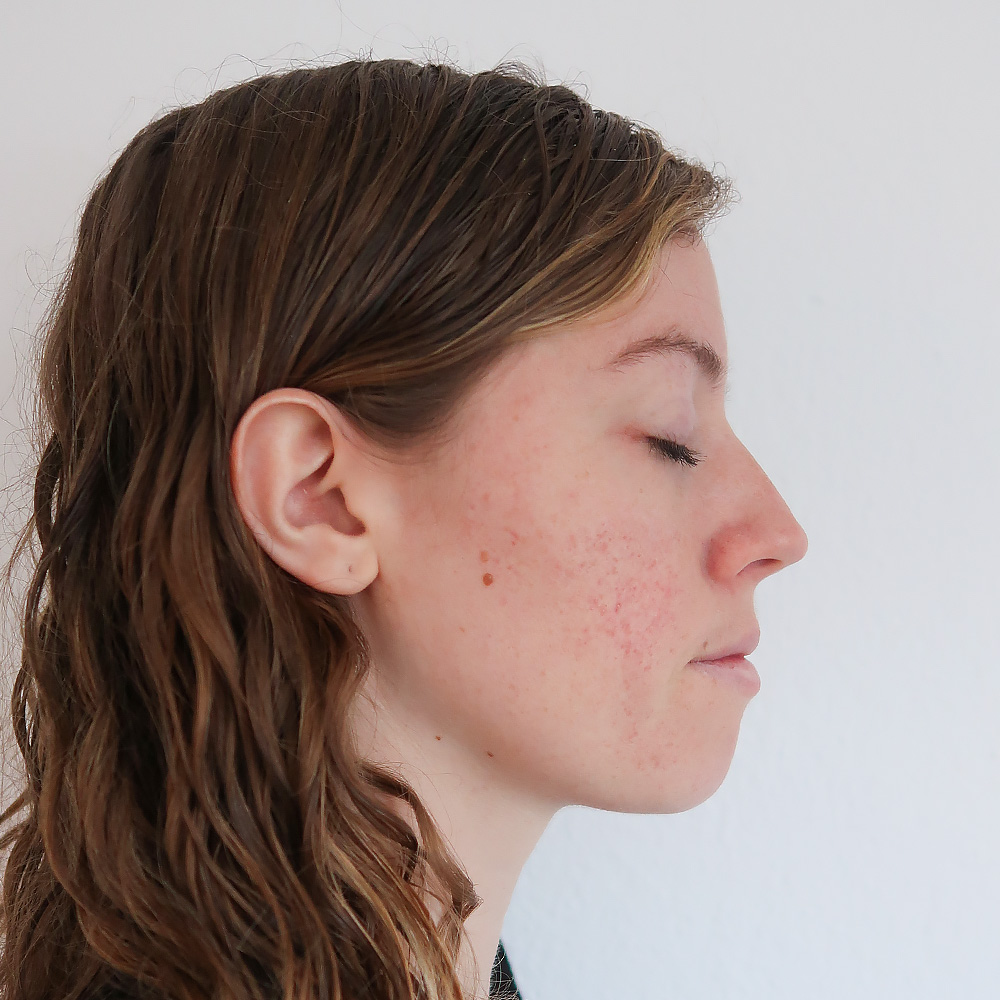 Seline Resultate Irritated Skin trockener Haut Pickeln Mitessern Flecken After