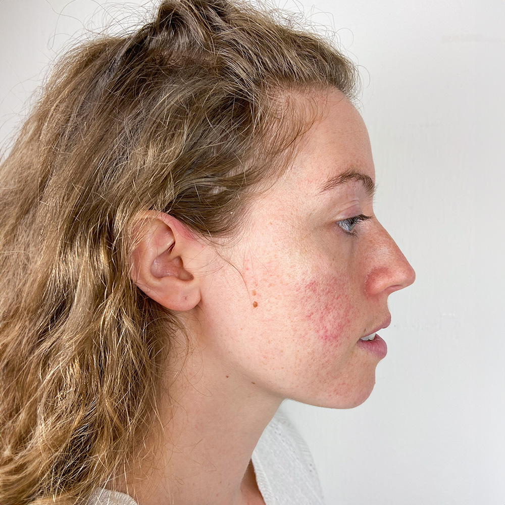 Seline Resultate Irritated Skin trockener Haut Pickeln Mitessern Flecken Before