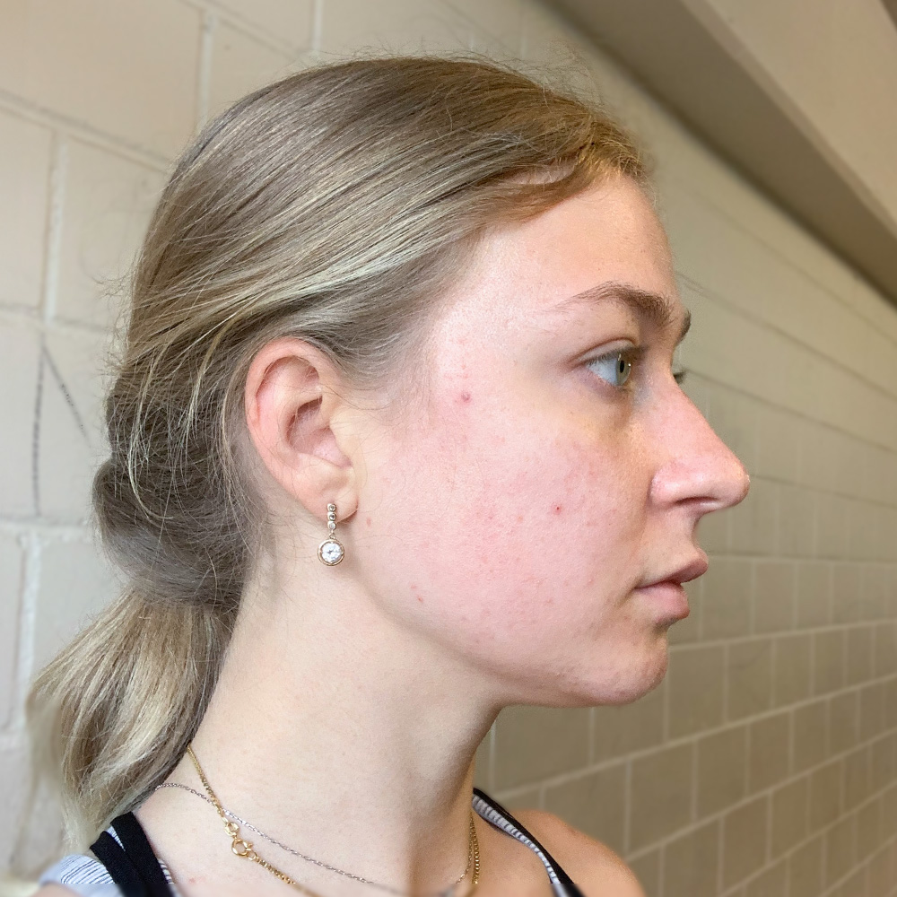 Sofia Resultate Skin Clear Young ölige T-zone After