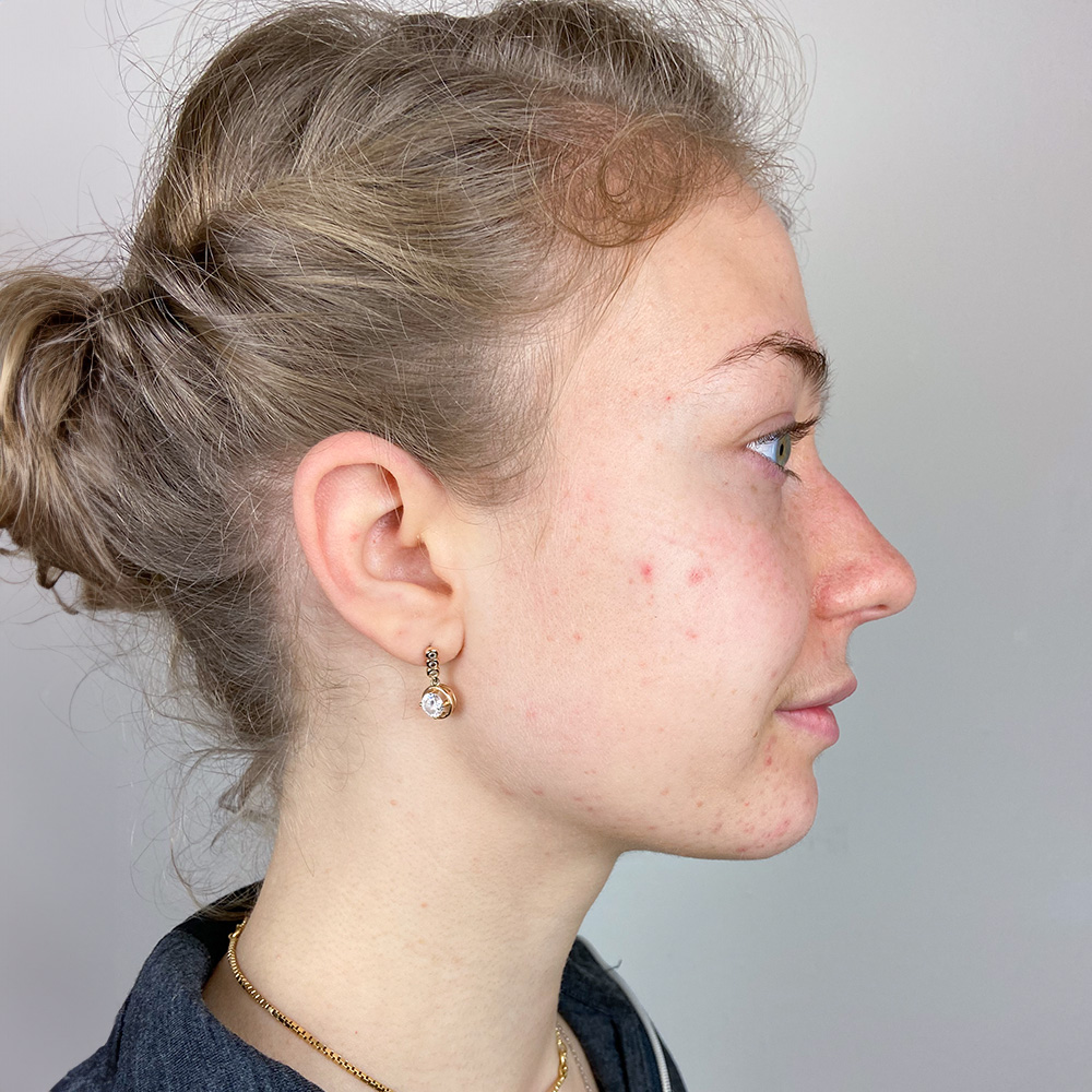 Sofia Resultate Skin Clear Young ölige T-zone Before