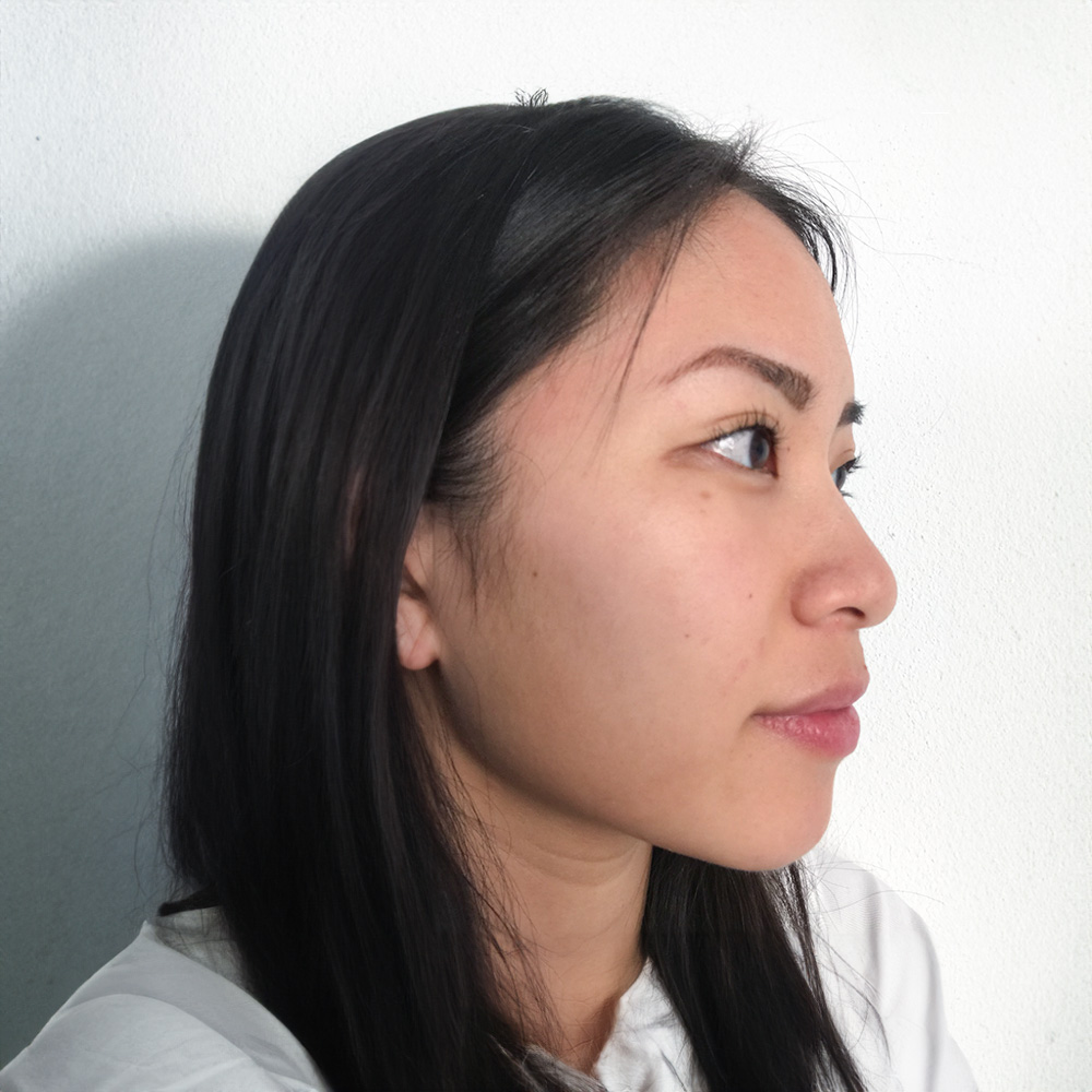 Sophie Pigmentstörungen Behandlung Pigmentflecken Altersflecken Resultate vorher nachher after