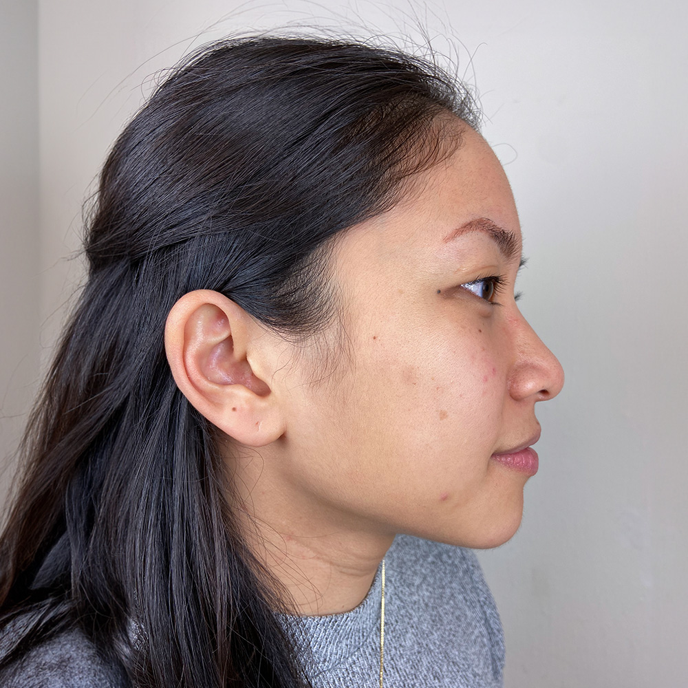 Sophie Pigmentstörungen Behandlung Pigmentflecken Altersflecken Resultate vorher nachher before