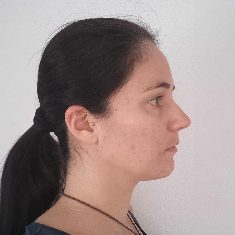 Sophie Pigmentstörungen Behandlung Pigmentflecken Altersflecken Resultate vorher nachher before