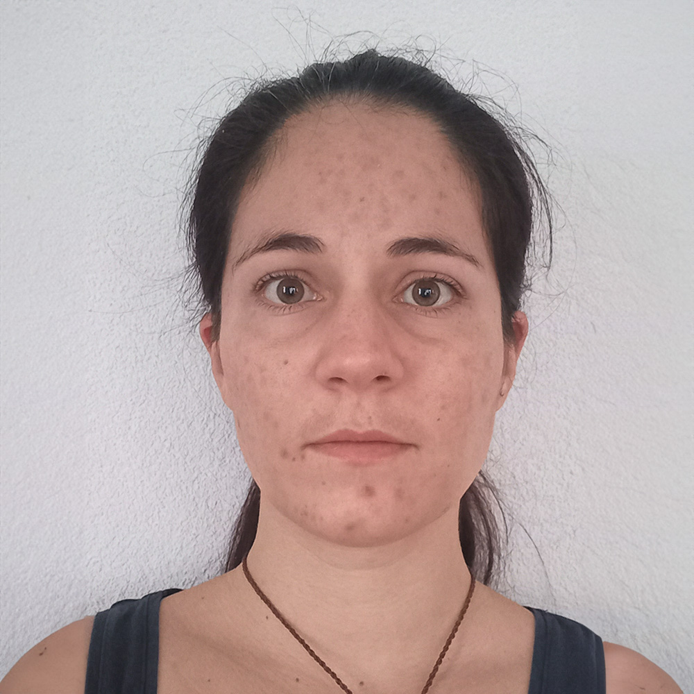 Sophie Pigmentstörungen Behandlung Pigmentflecken Altersflecken Resultate vorher nachher before