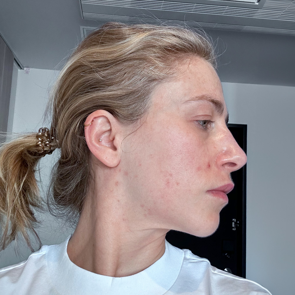 Tanja Behandlung Pigmentflecken Altersflecken after